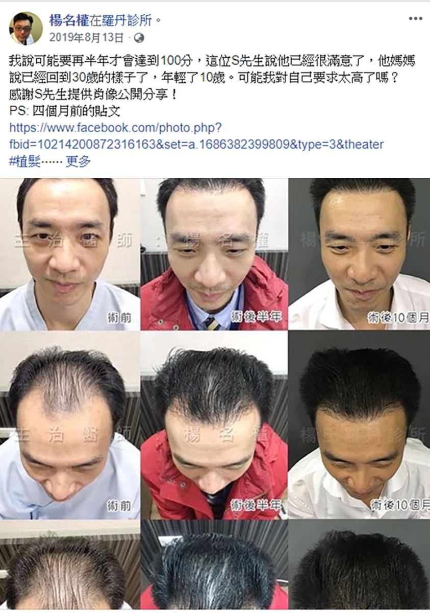 植髮,楊氏羅丹,生髮613 禿頭 掉髮